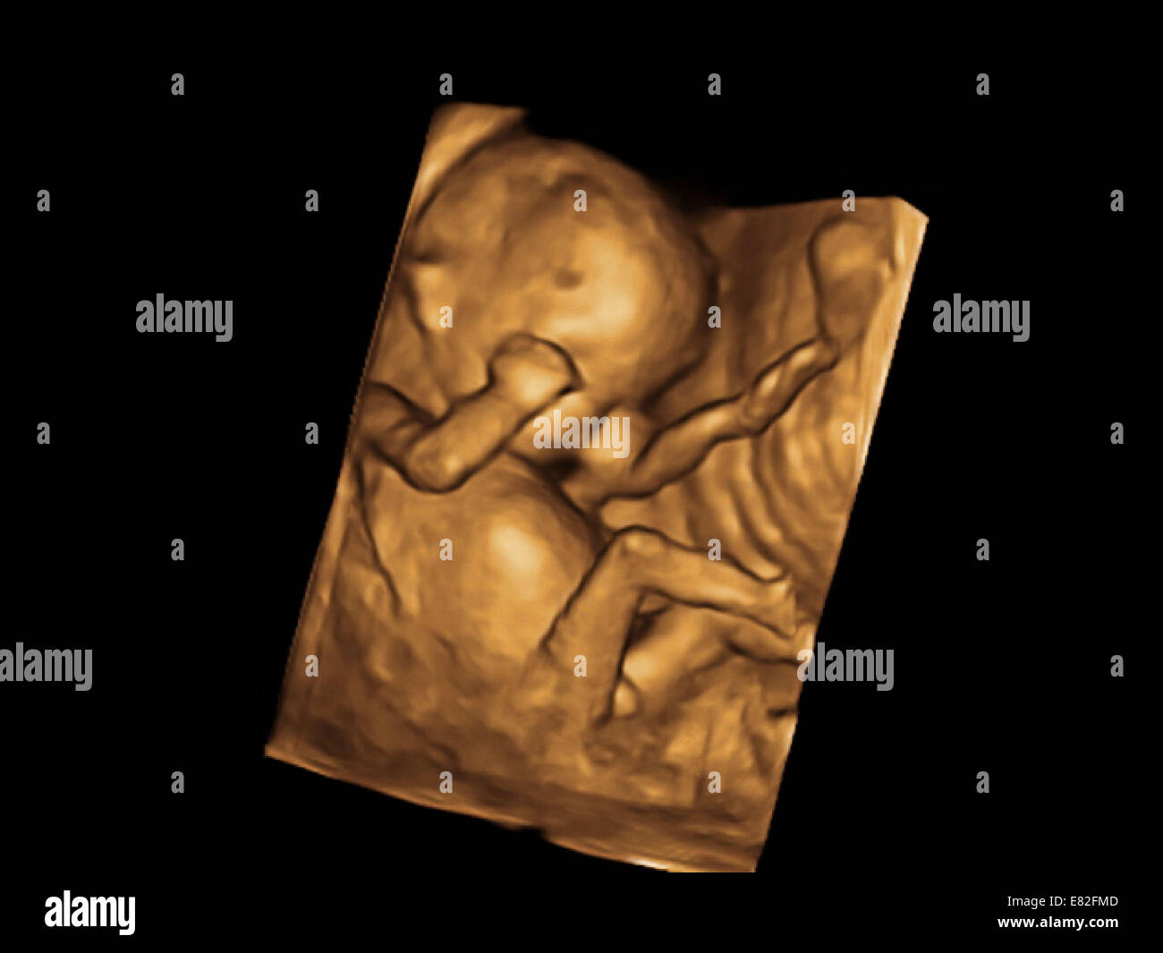 Coloured 3-D ultrasound scan of a foetus, Gestational age : 12 weeks and 5 days. Stock Photo