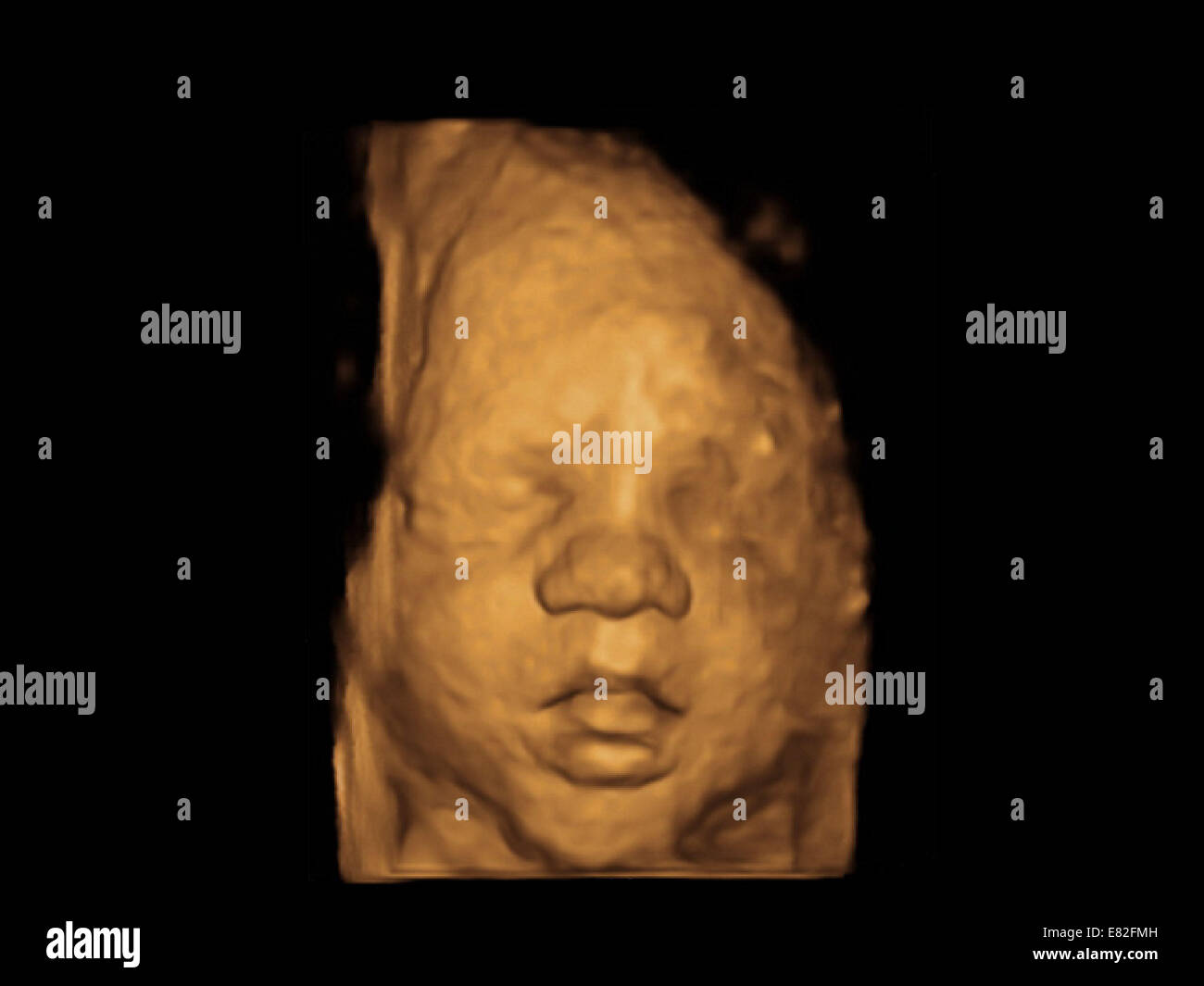 Foetus' face, Coloured 3D ultrasound scan of a foetus, Gestational age