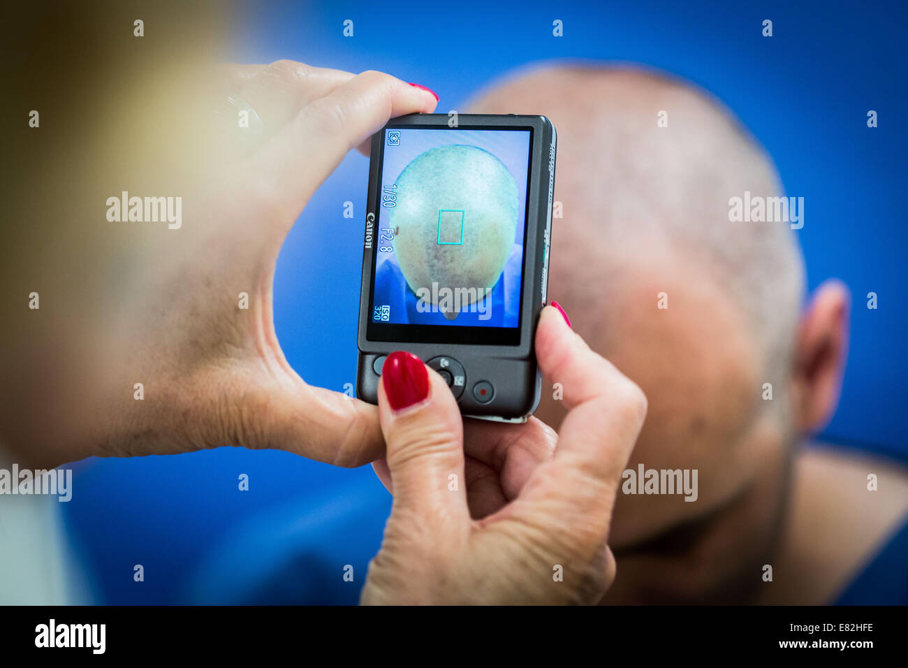 Micrografting hair follicle extraction, FUE Follicular Unit Extraction