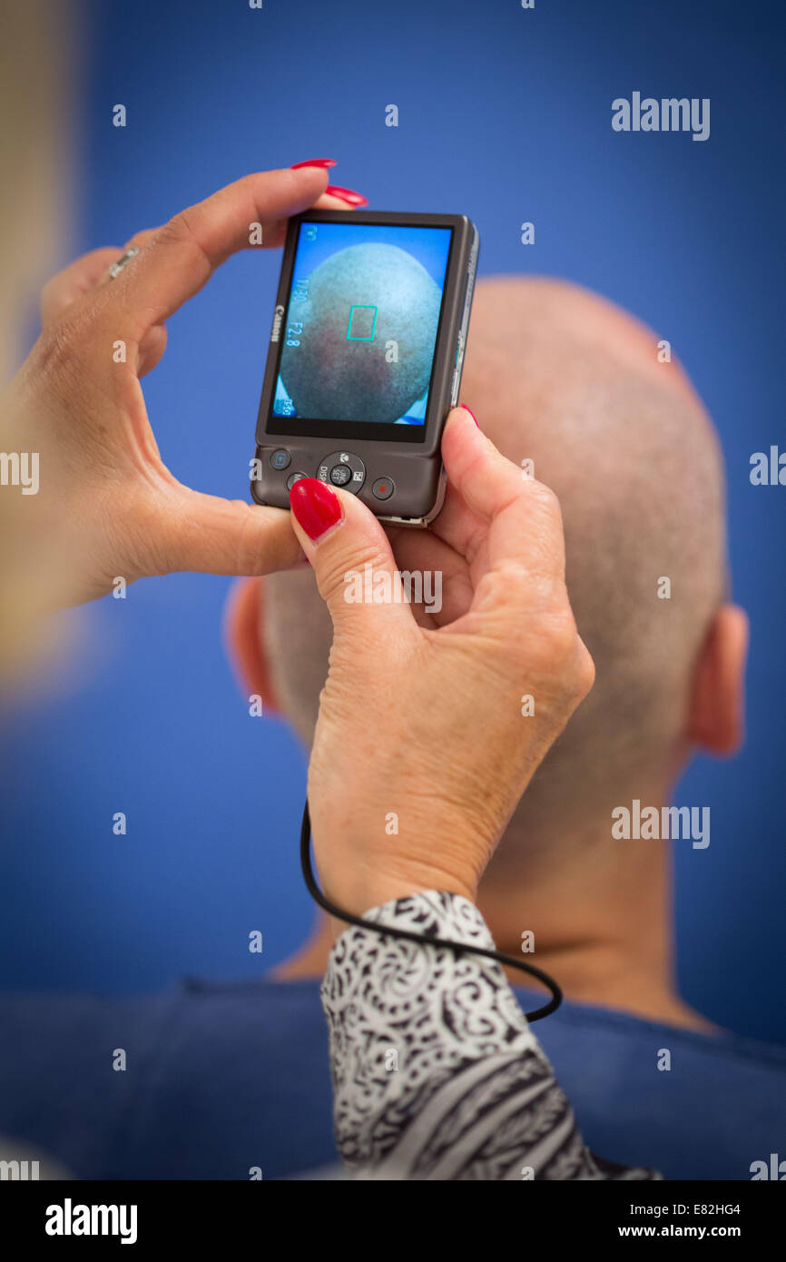 Micrografting hair follicle extraction, FUE Follicular Unit Extraction