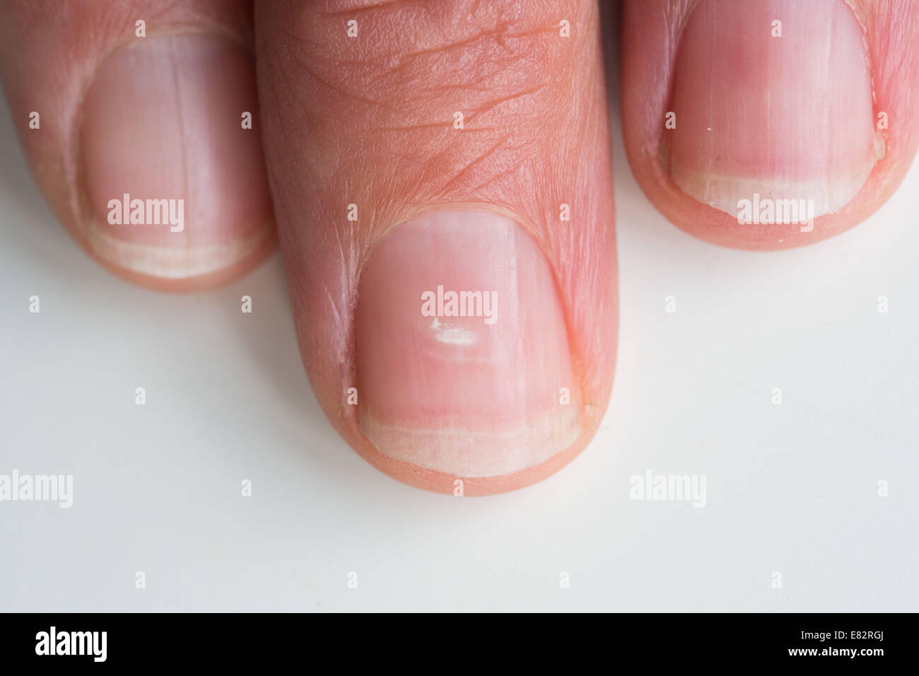 White spot on a nail Stock Photo - Alamy