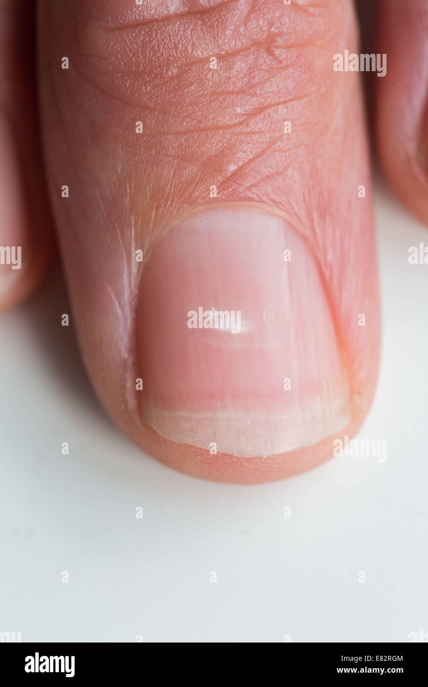 White spot on nail hi-res stock photography and images - Alamy