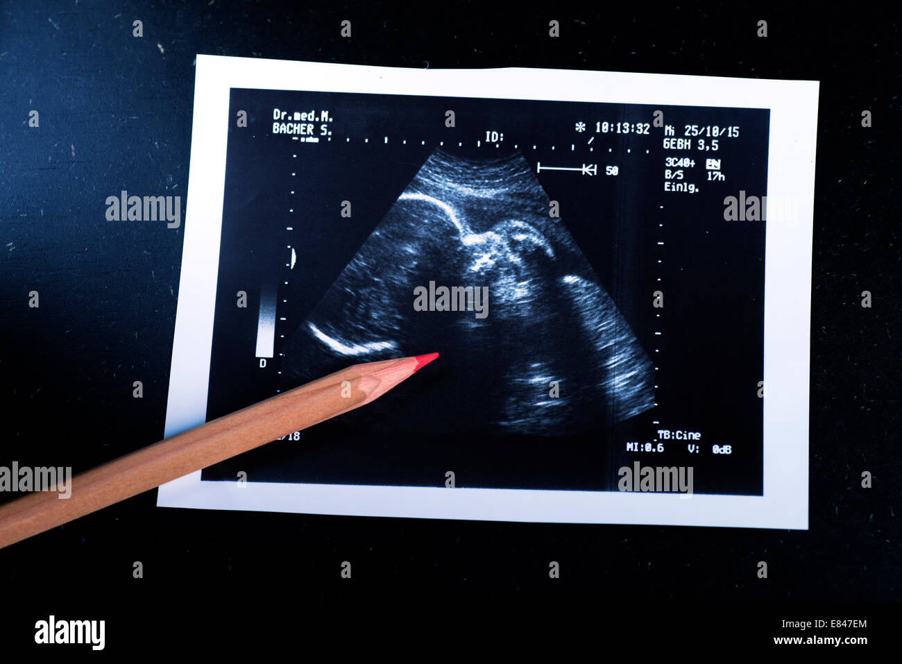 Sonography of an embryo in the womb Stock Photo