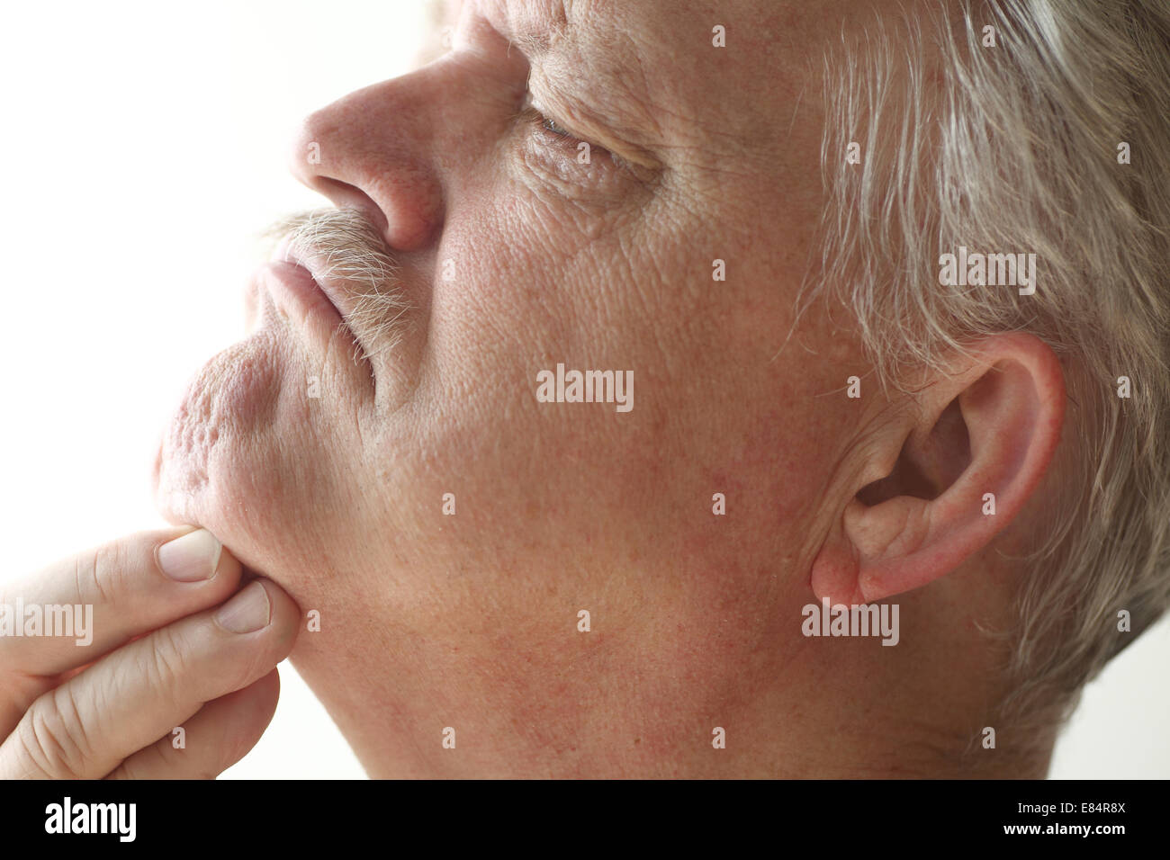 Older man has irritation on the skin under his chin. Stock Photo