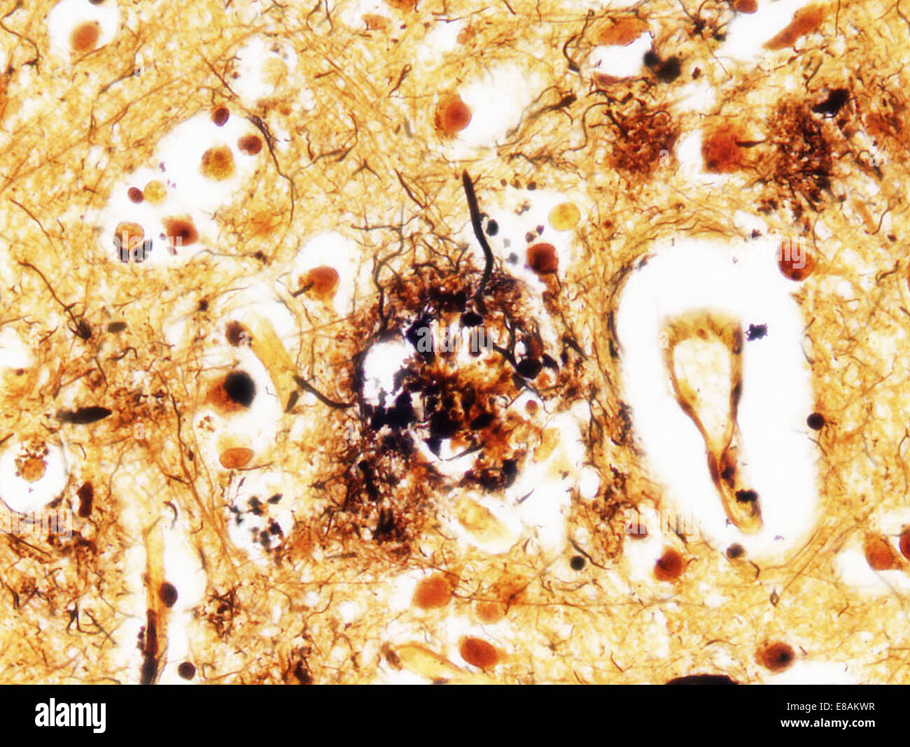 Alzheimer's disease, neuritic plaques Stock Photo