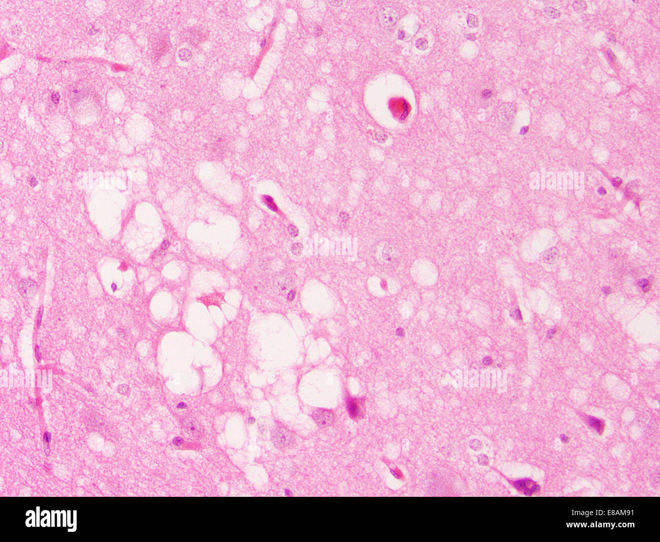 Prion disease, spongiform encephalopathy Stock Photo - Alamy