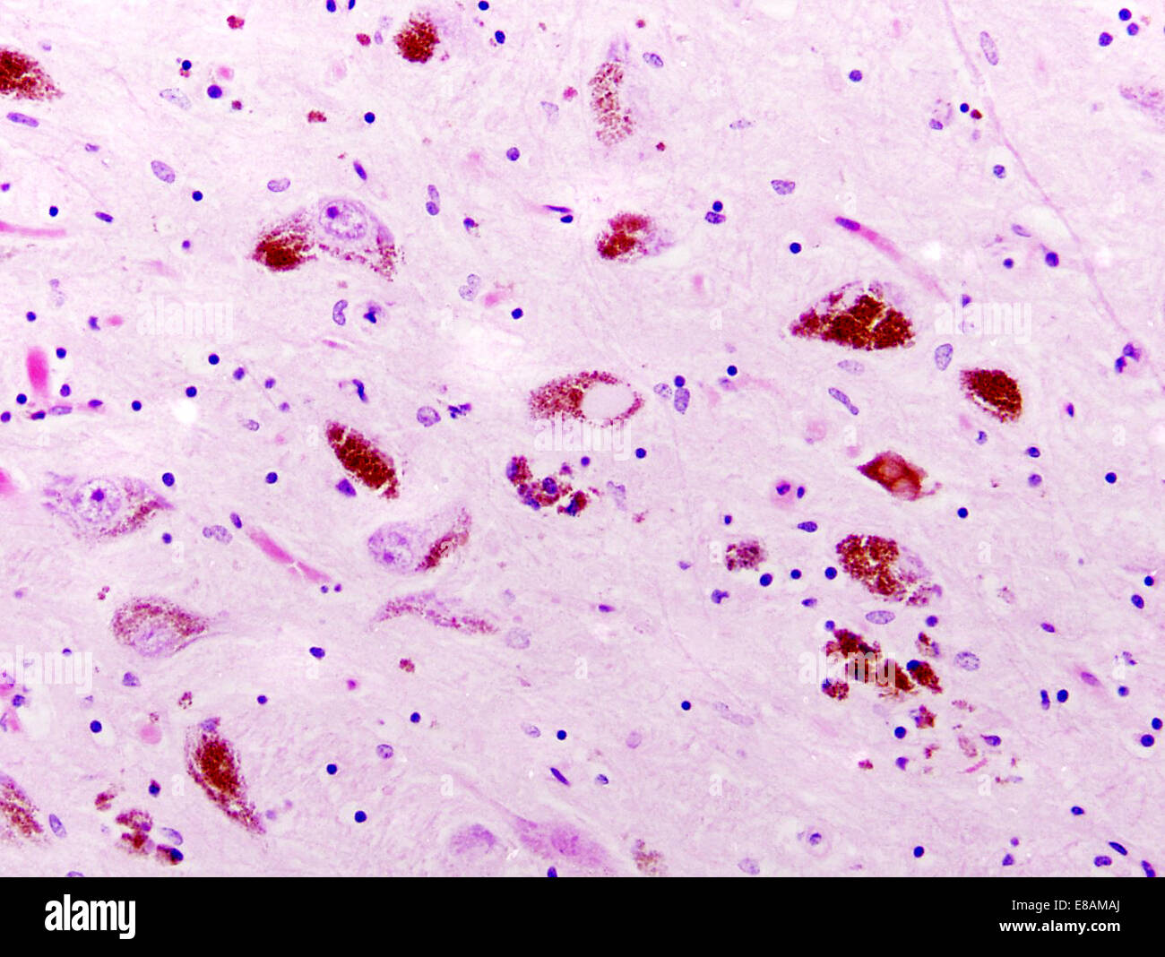 Parkinson's disease, substantia nigra, Lewy bodies Stock Photo