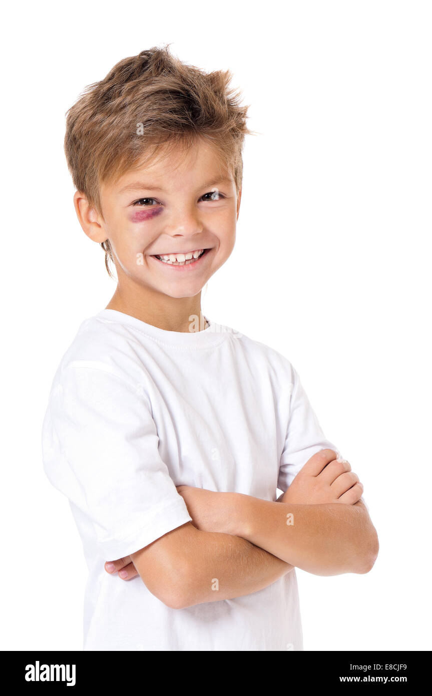 Boy with bruise Stock Photo