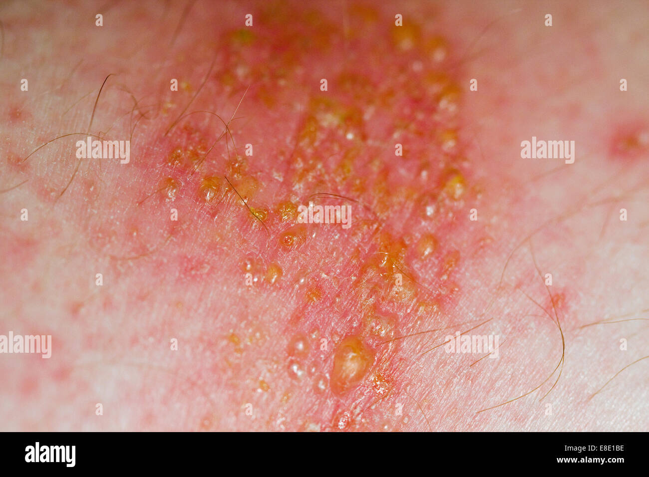 Non-Bullous impetigo infection on the surface of skin caused by either staphylococcus aureus or streptococcus pyogenes bacteria Stock Photo