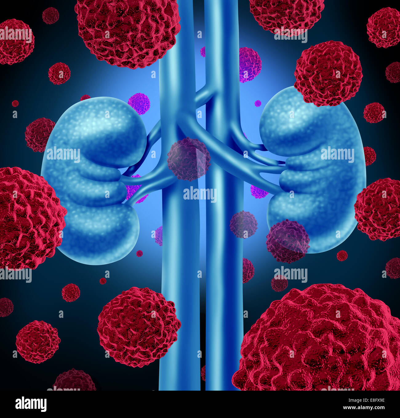 Kidney cancer medical concept as cancerous cells in a human body attacking the urinary system and renal anatomy as a symbol for Stock Photo