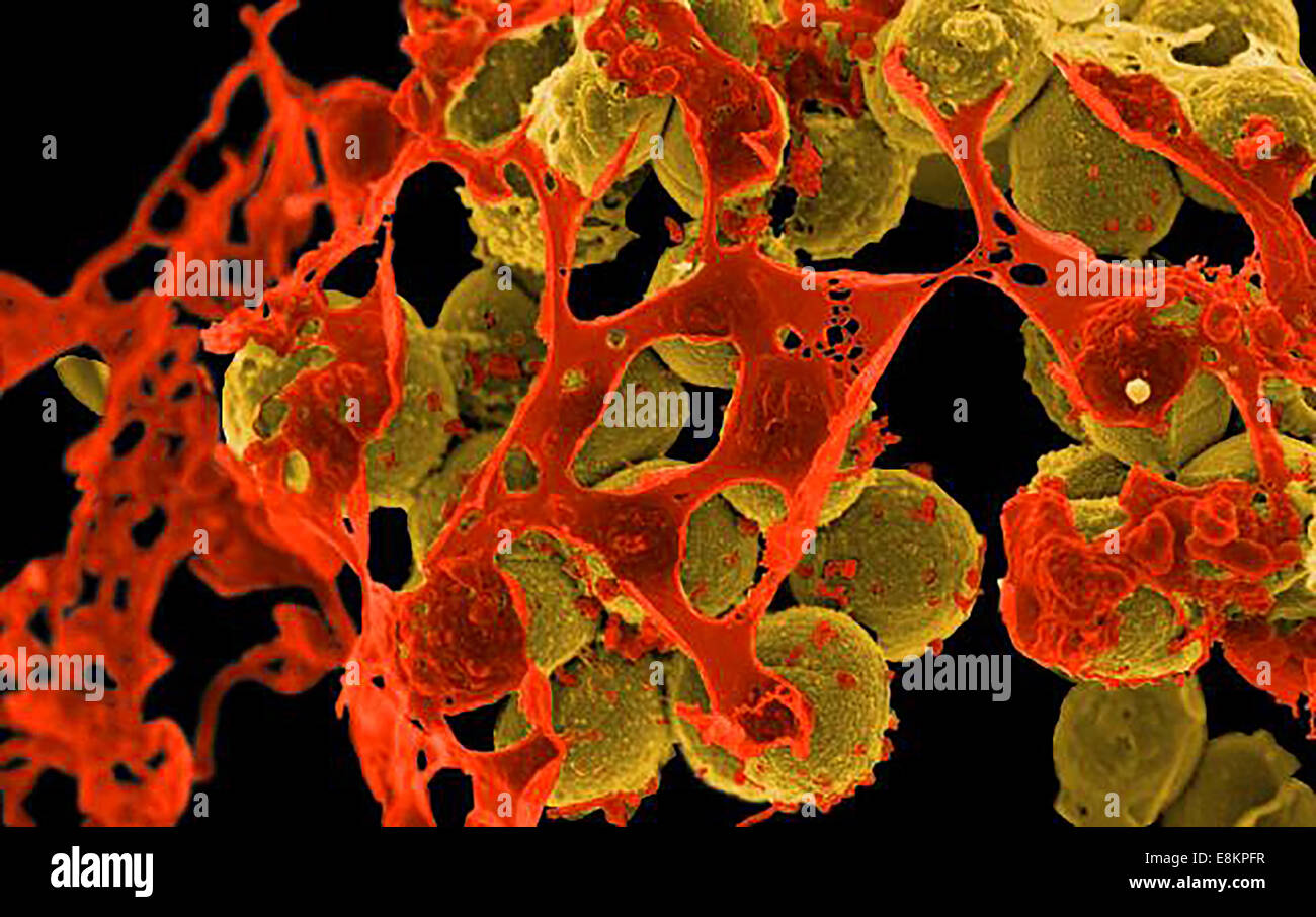 Scanning electron micrograph of methicillin-resistant Staphylococcus aureus (MRSA, brown) surrounded by cellular debris MRSA Stock Photo