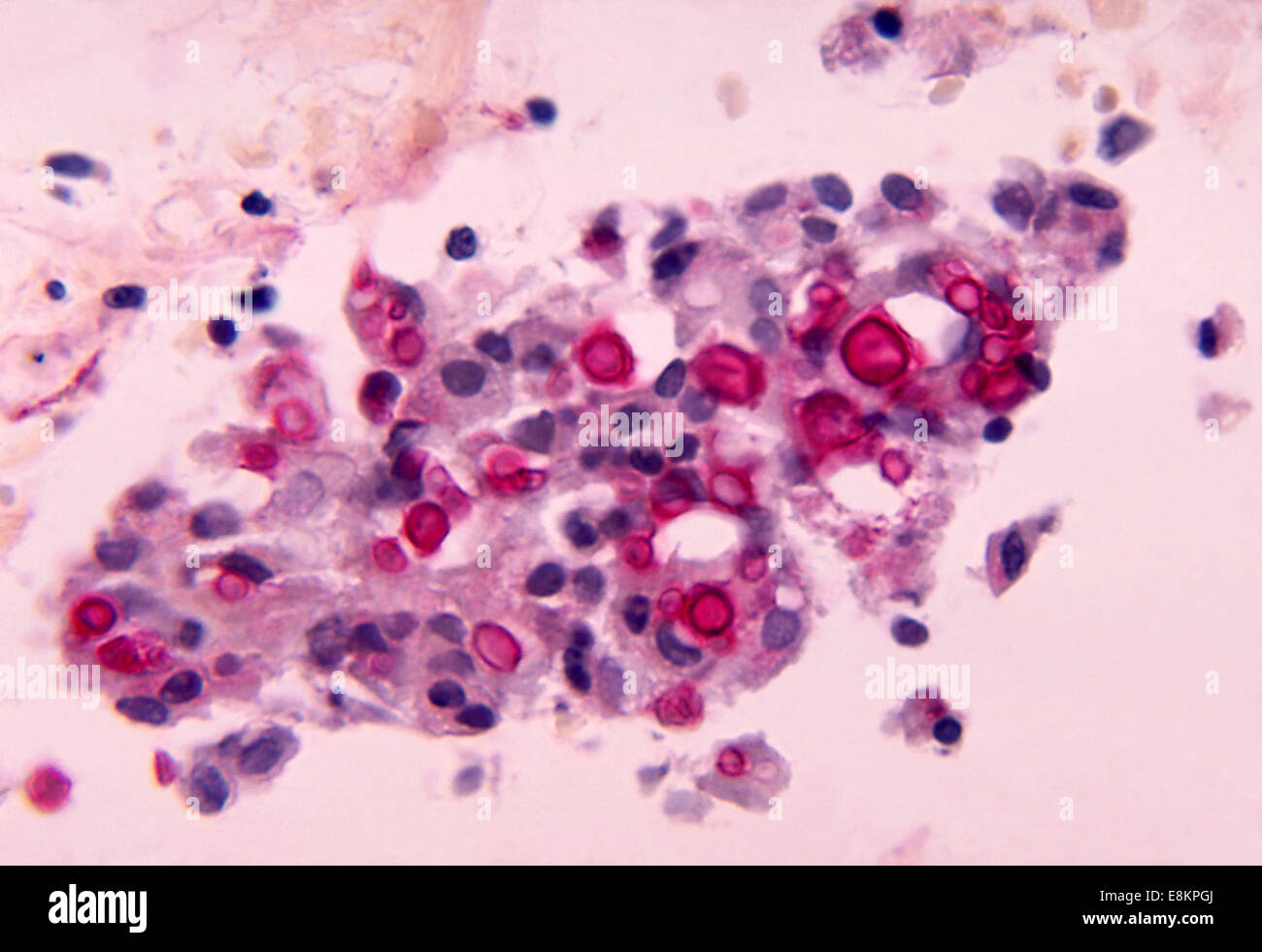 This micrograph depicts histopathologic changes associated with cryptococcosis of lung using Mucicarmine stain Cryptococcosis, Stock Photo