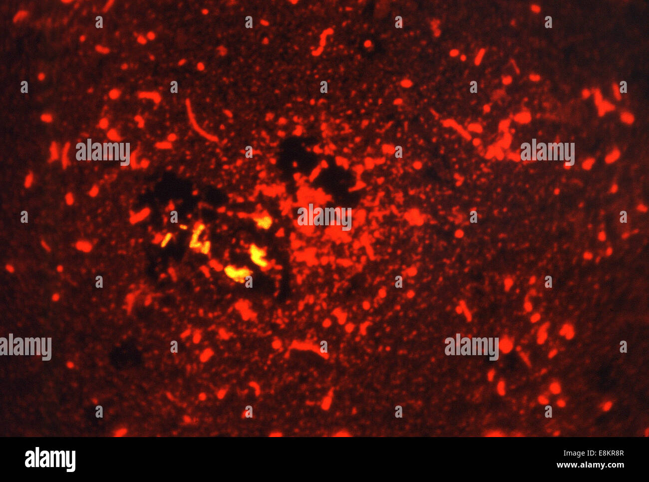 This fluorescent acidfast stained (Smithwick) photomicrograph revealed presence of