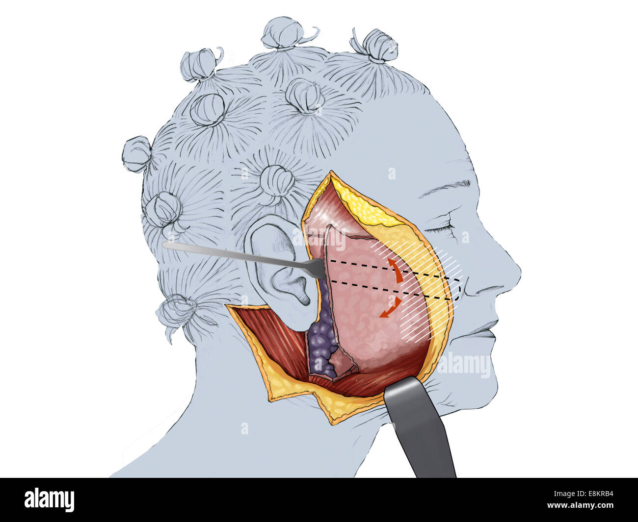 Cervico-facial lift, detachment of the superficial muscular aponeurotic system (SMAS). Stock Photo