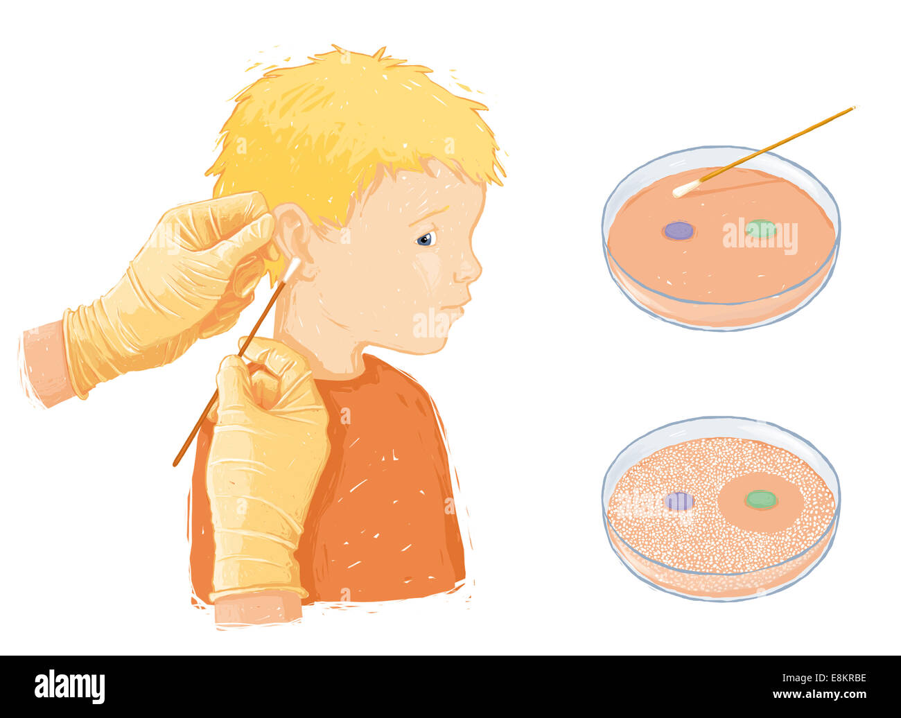 Taking bacteria sample from childs infected ear (otitis), in preparation for an antibiogram An antibiogram tests sensitivity Stock Photo