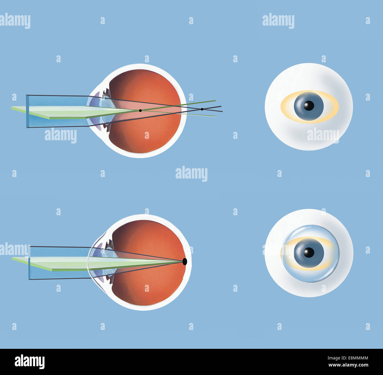 Astigmatism and correction with corrective lens. Stock Photo