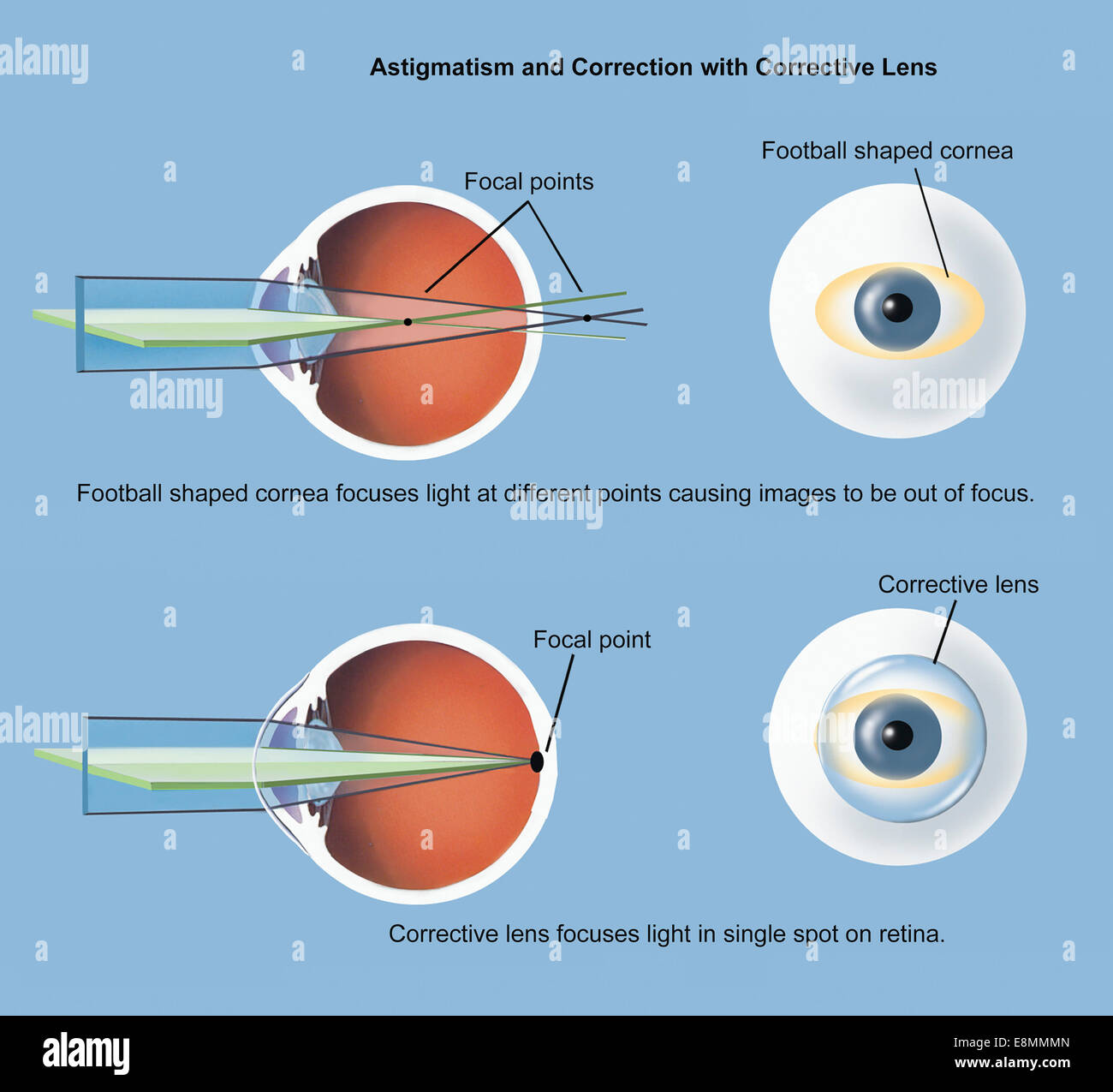 Astigmatism and correction with corrective lens. Stock Photo