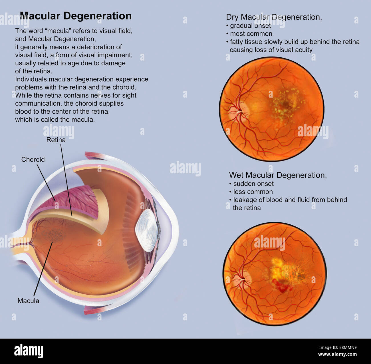 Retina with macular degeneration. Stock Photo