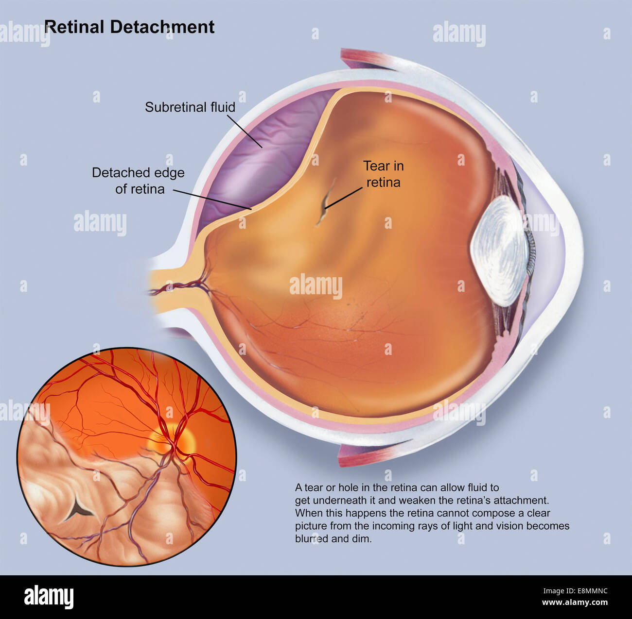 Diagram of a retinal detachment. Stock Photo