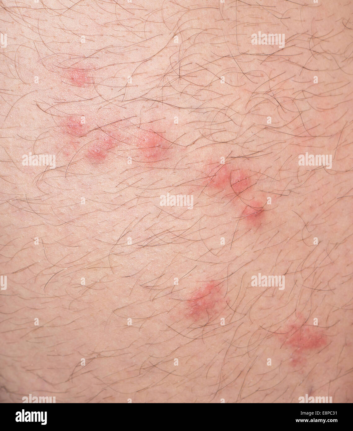 close up view of flea bites over caucasian man leg skin Stock Photo Alamy