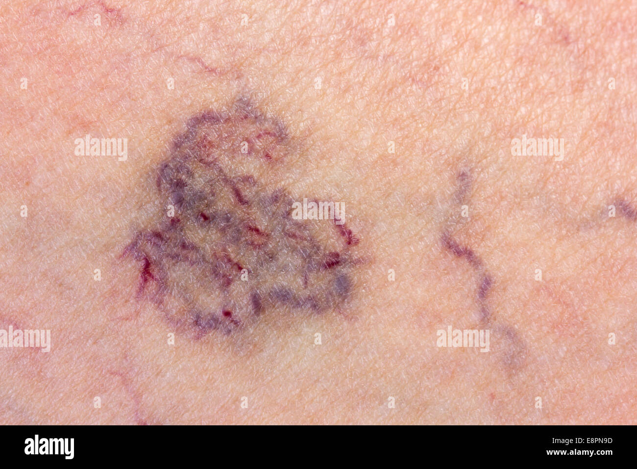 Close-up of skin with varicose veins Stock Photo