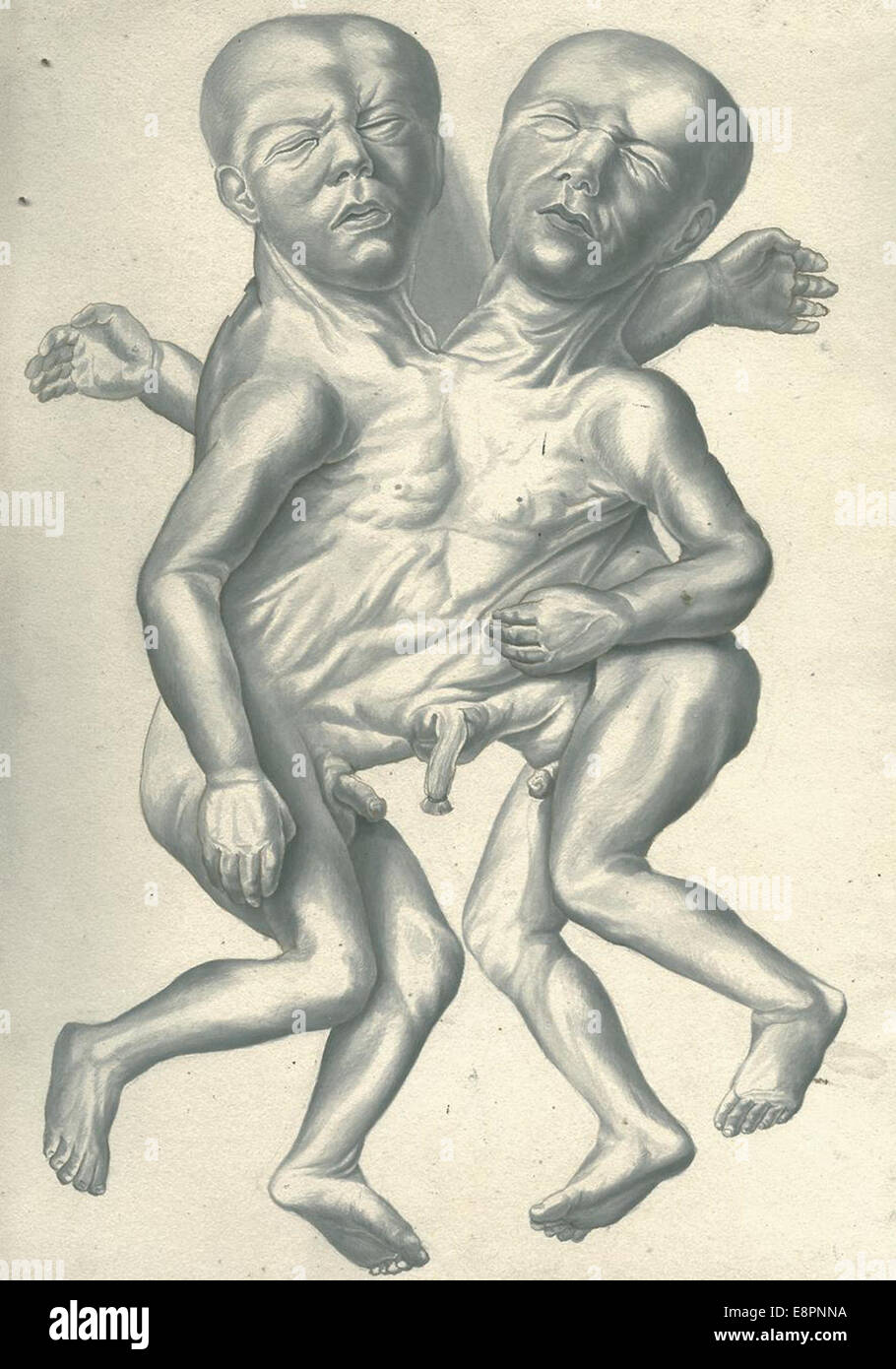 Date: ca. 1820-1840  Image Description: Double-headed conjoined twins. Stock Photo
