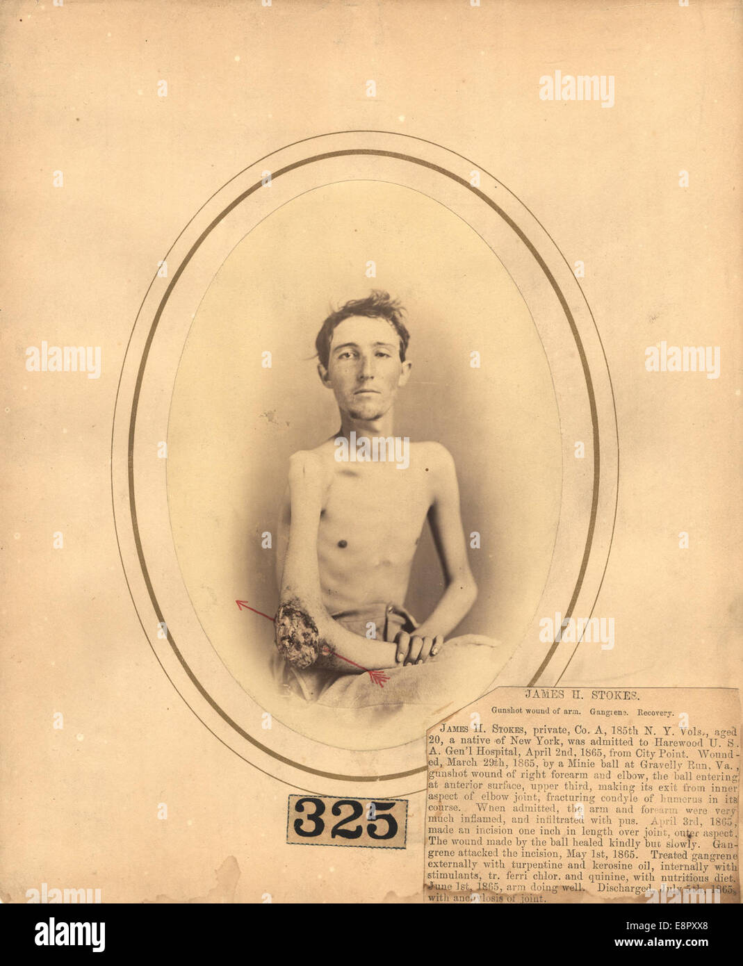 This photograph is part of a medical series commissioned by Surgeon General William Hammond for the Medical and Surgical History of the War of the Rebellion. It depicts a man with a gangrenous elbow, showcasing wartime injuries during the American Civil War. Stock Photo