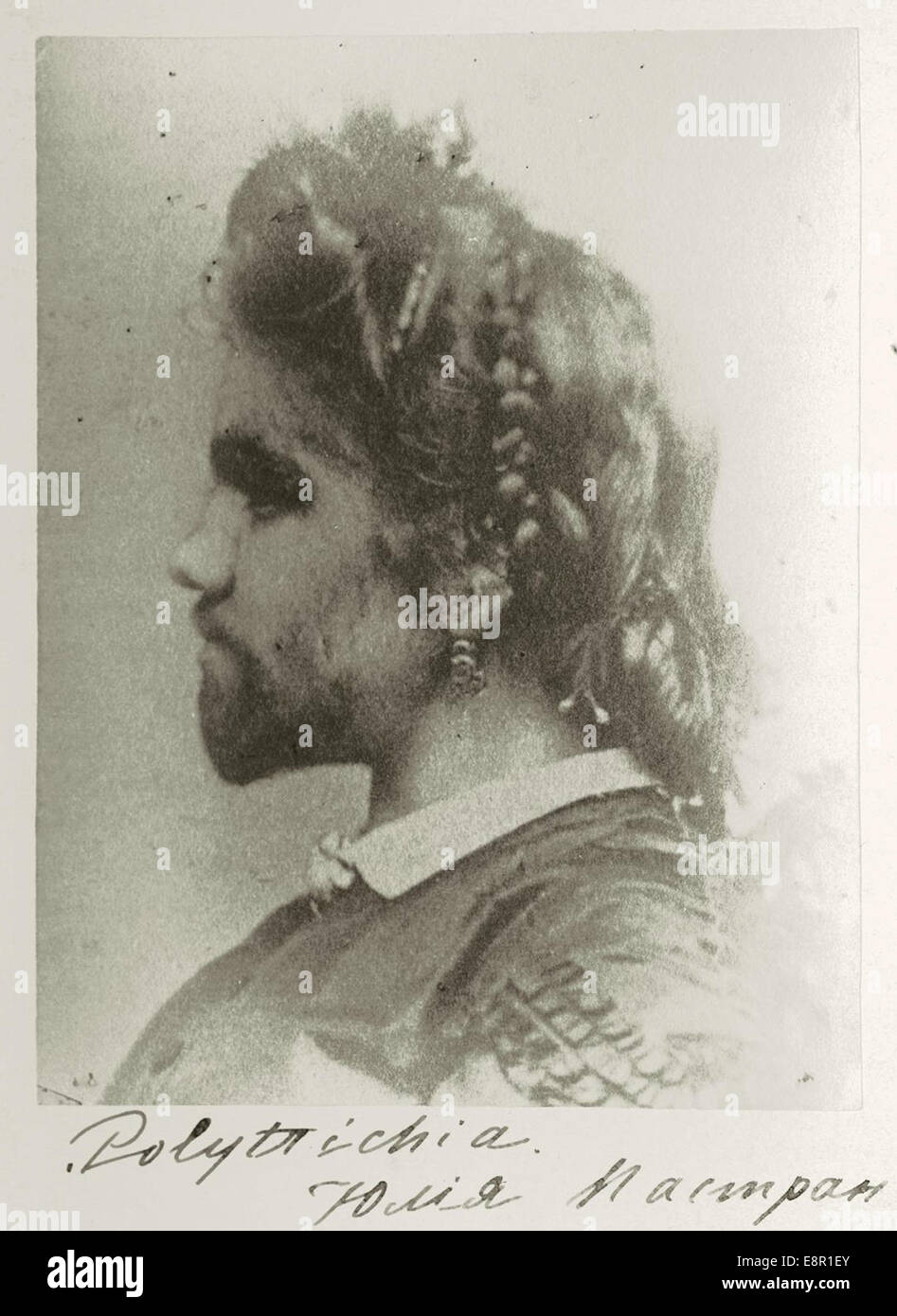 This photograph depicts Julia Pastrana (1834-1860), known as 'the Bearded Lady', a Mexican woman with hypertrichosis who toured Europe and North America in the 1850s. She became a sensation due to her distinctive appearance. Stock Photo