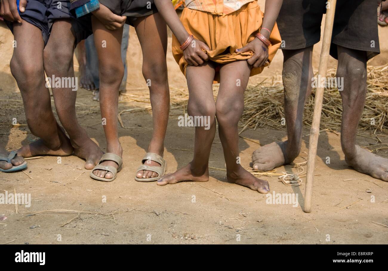 Skeletal fluorosis from drinking high levels of fluoride naturally occurring in their groundwater system Stock Photo