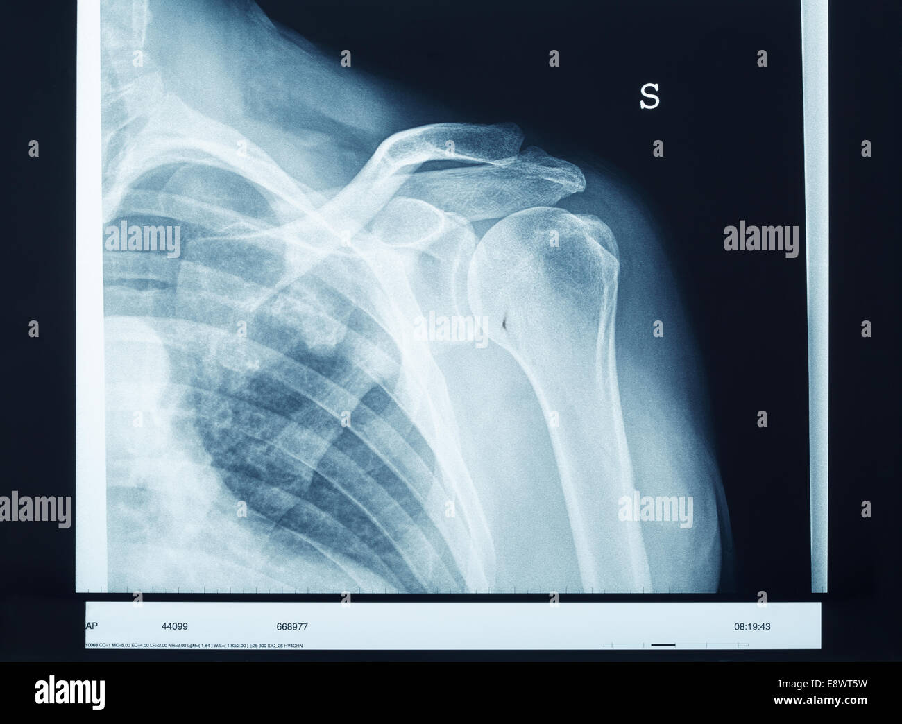 X-ray shoulder Stock Photo