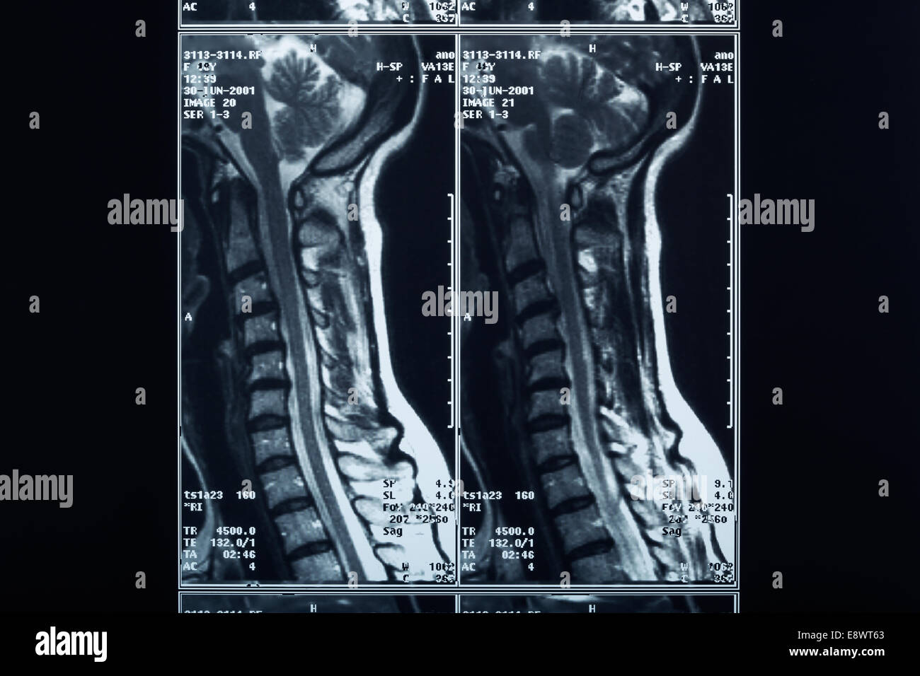 X-ray spine and neck Stock Photo