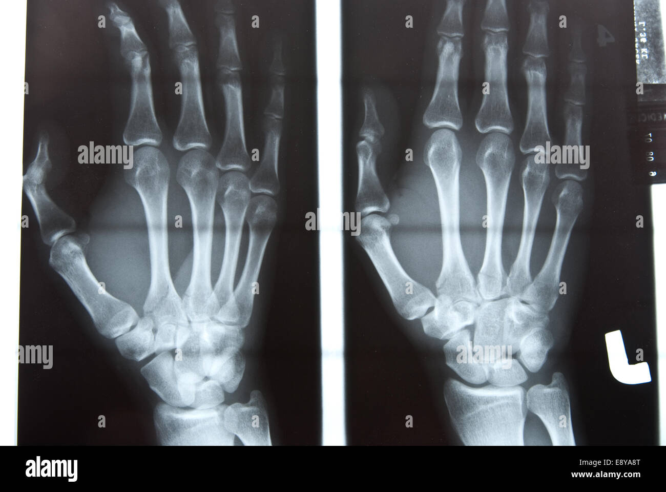 human hand xray image Stock Photo Alamy