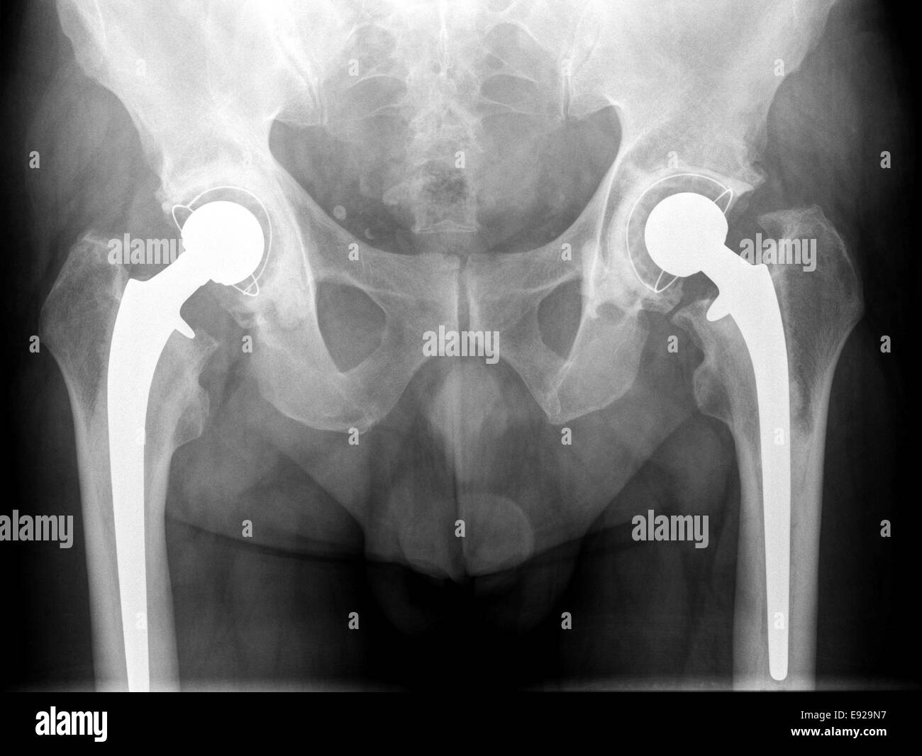 X-ray of the hip prosthesis elderly man Stock Photo
