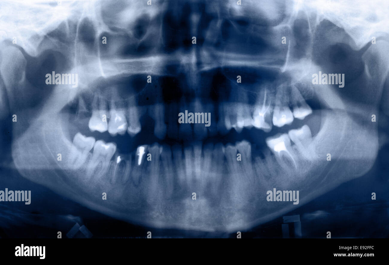 Panoramic dental XRay Stock Photo Alamy