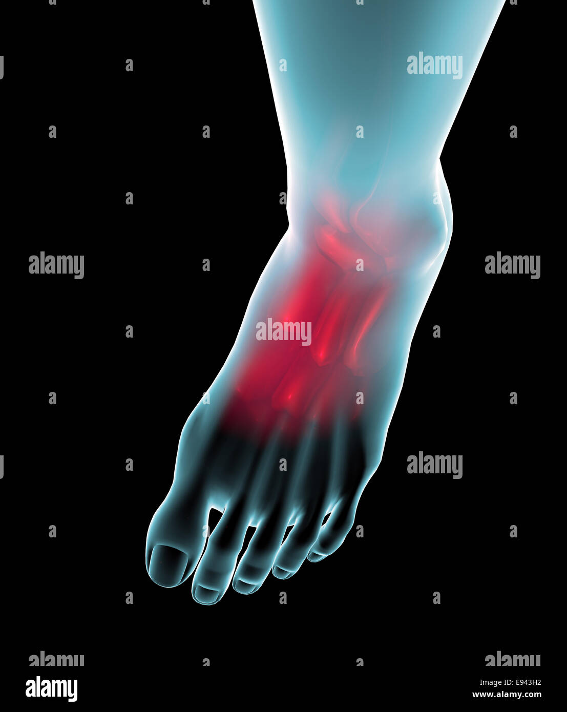 Foot seen on x-ray with pain in the ankle and the plant Stock Photo