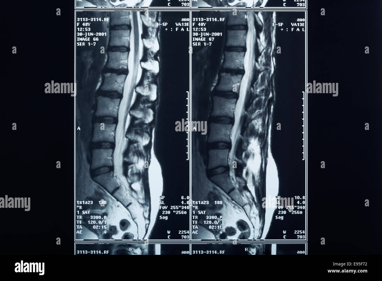 X-ray spine radiography Stock Photo
