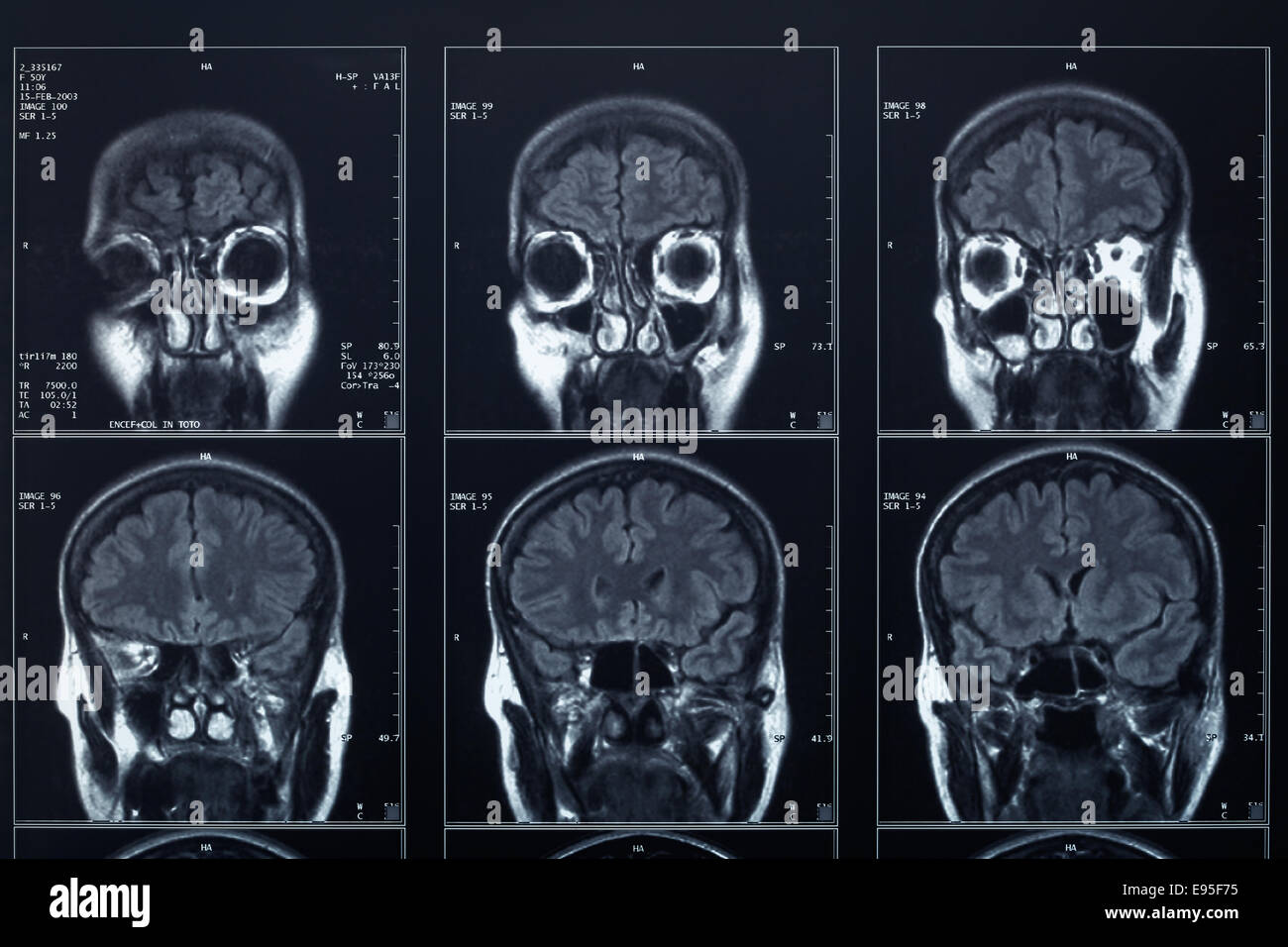 Brain xray hires stock photography and images Alamy