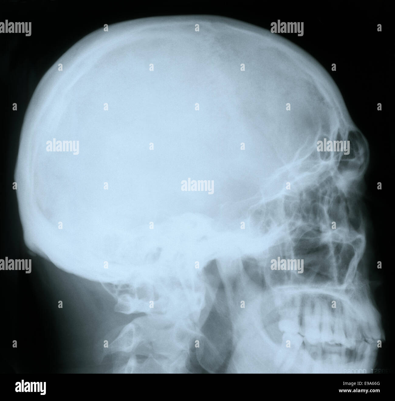 X-ray of a human skull Stock Photo