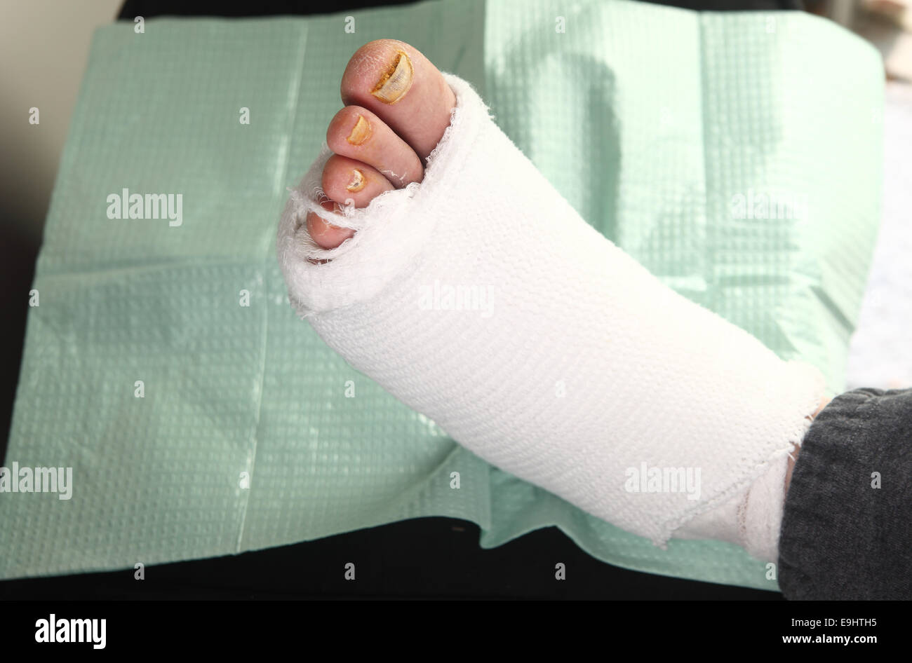 A man with a bandaged diabetic foot infection and toenail fungus Stock Photo