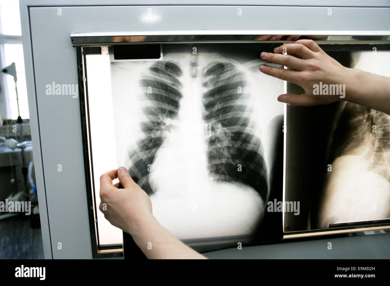 Person holding up chest xray to light box Stock Photo Alamy