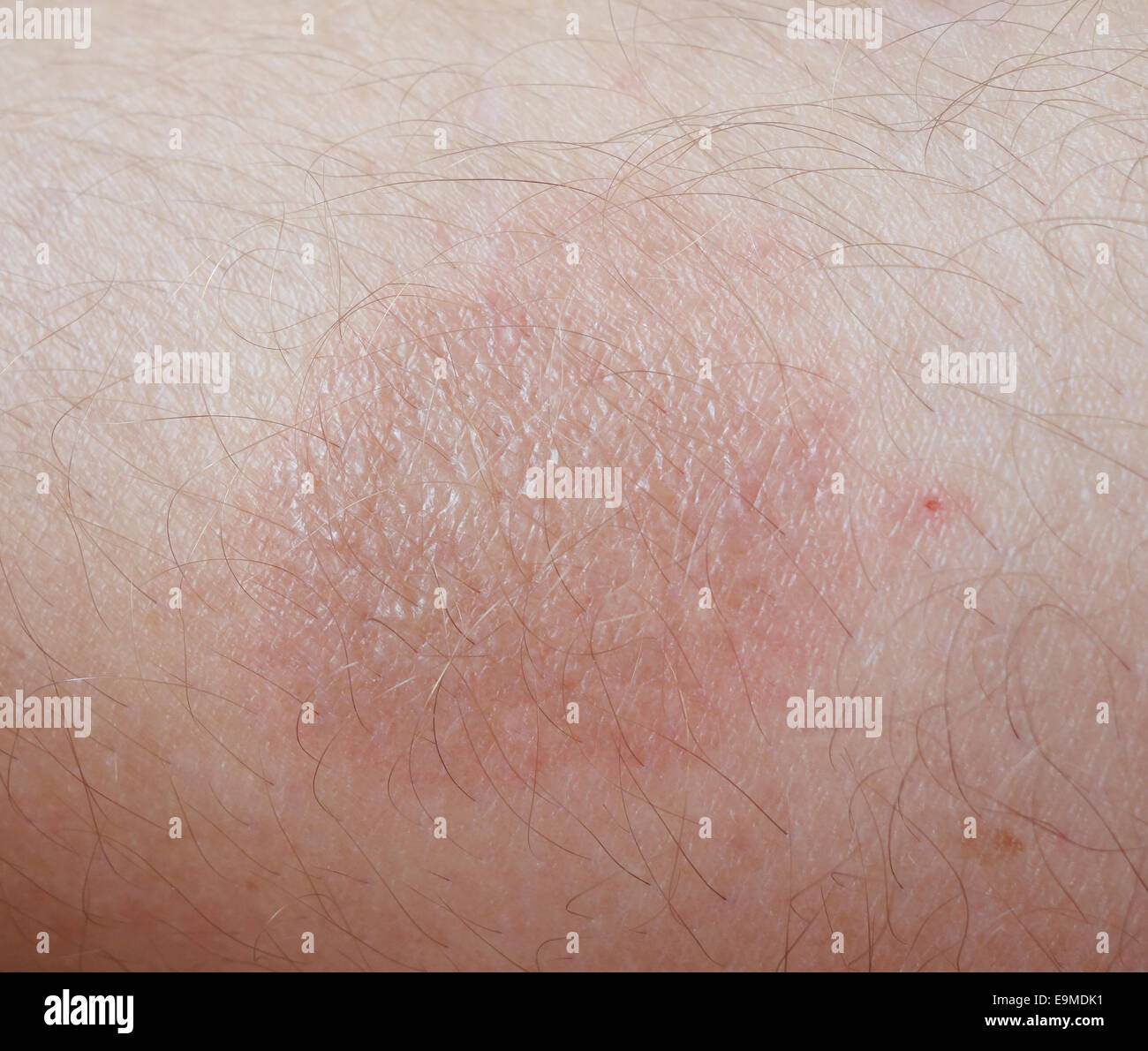 burn scar stock photo 57476164 burn scar stock photos burn scar stock images alamy burn scar stock photo 57476164 burn scar stock photos burn scar stock images alamy