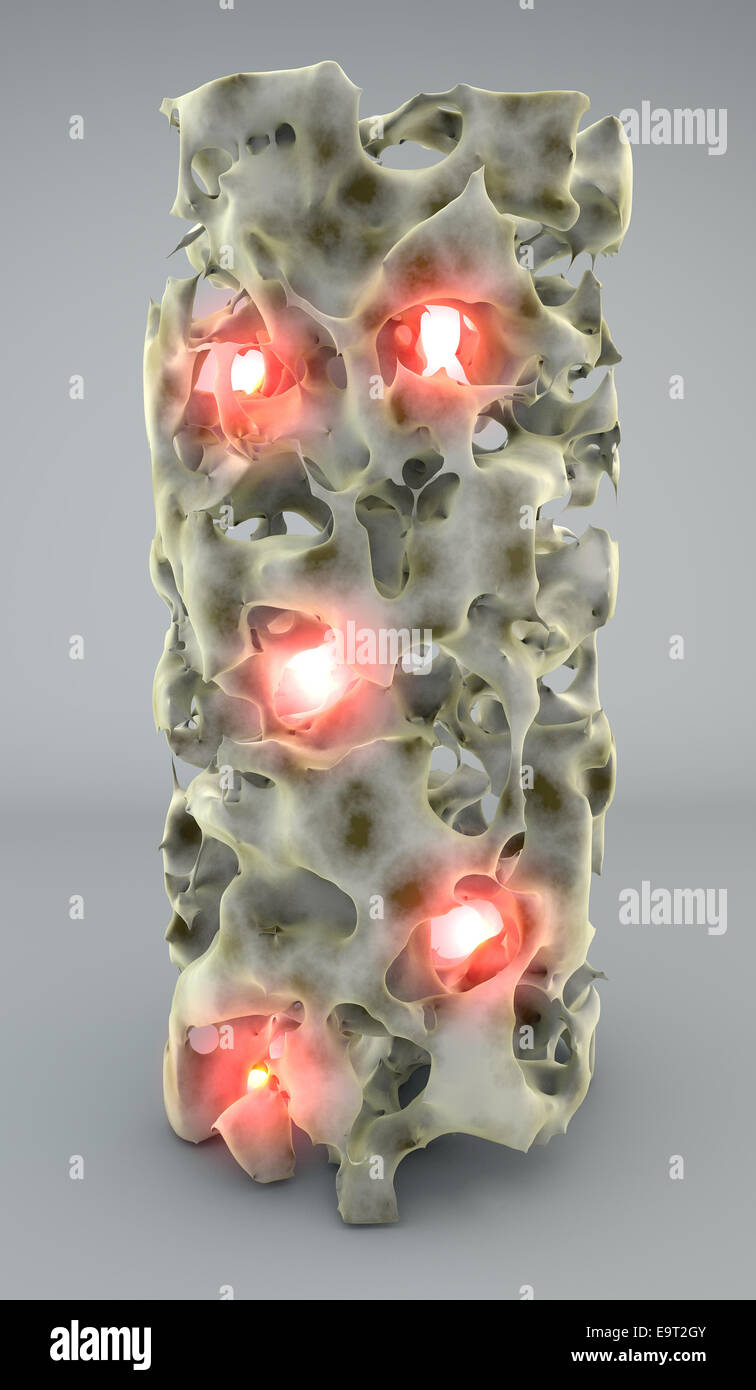3d Section of bone with osteoporosis,anatomy bone Stock Photo - Alamy