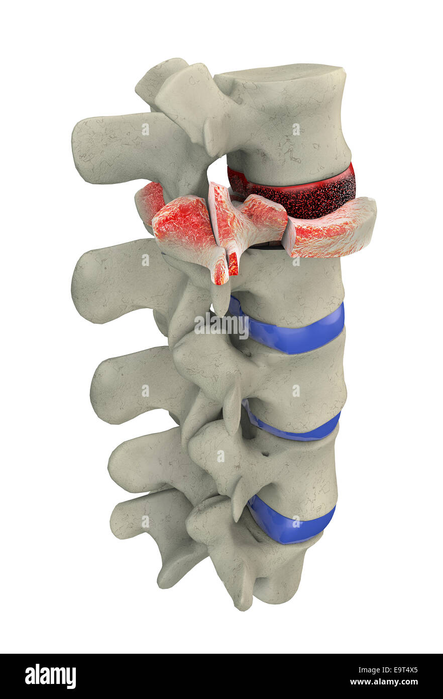3d illustration of part of human spine, traumatic vertebral fracture, burst fracture Stock Photo