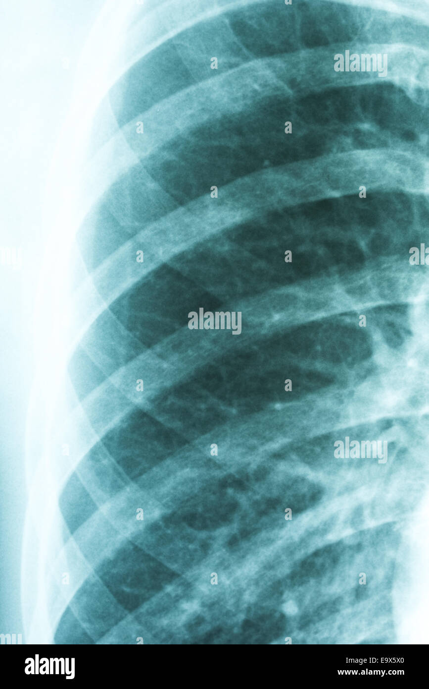 Bronchiectasis High Resolution Stock Photography And Images Alamy