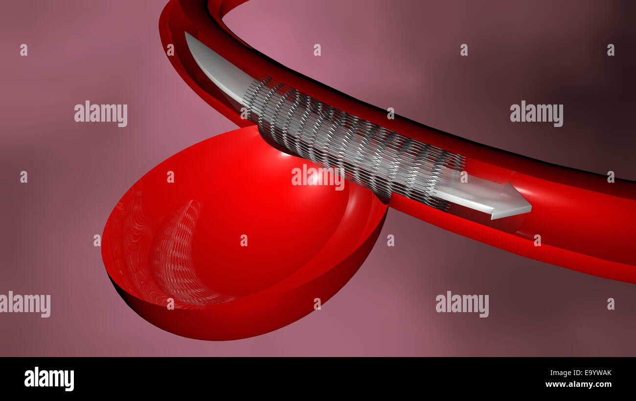 Aneurysm and endovascular treatment, stent Stock Photo