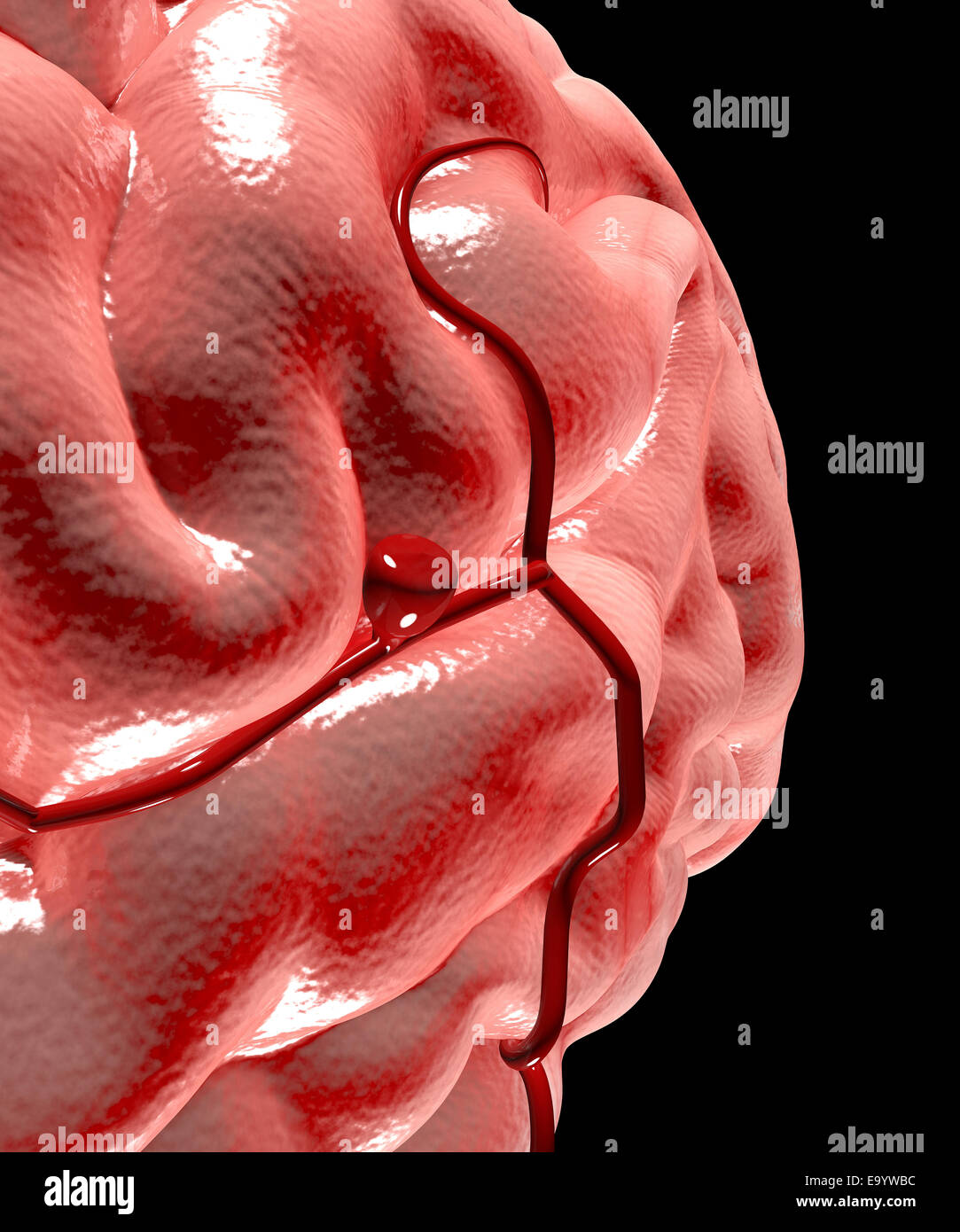 Enlargement of the brain with cerebral aneurysm Stock Photo
