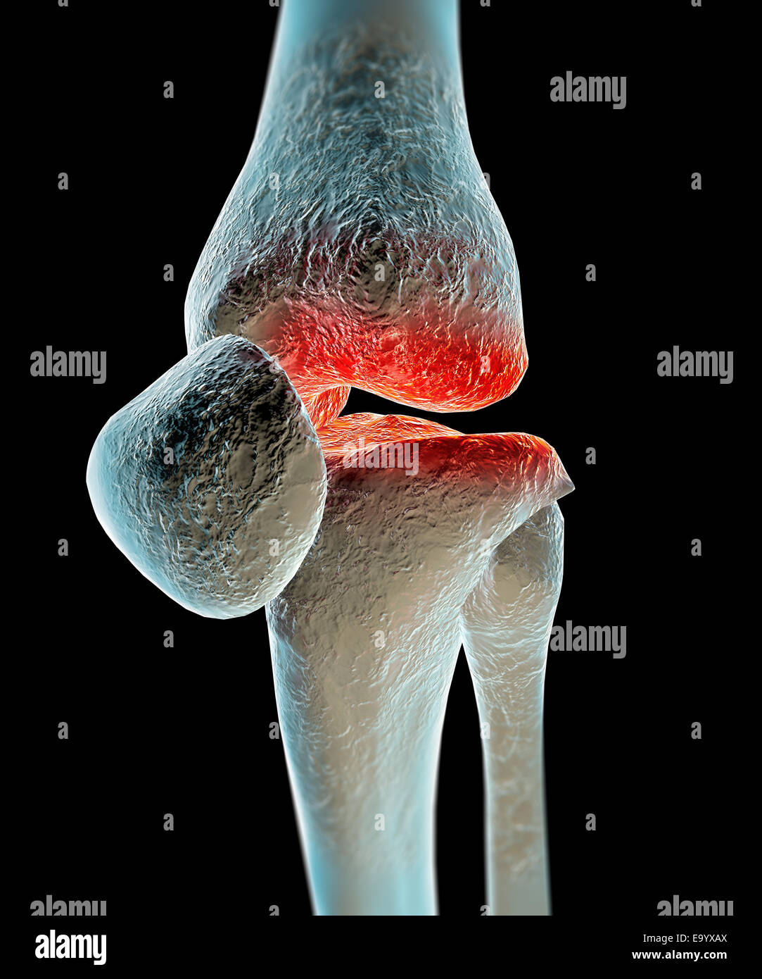 Human femur leg bone pain Stock Photo