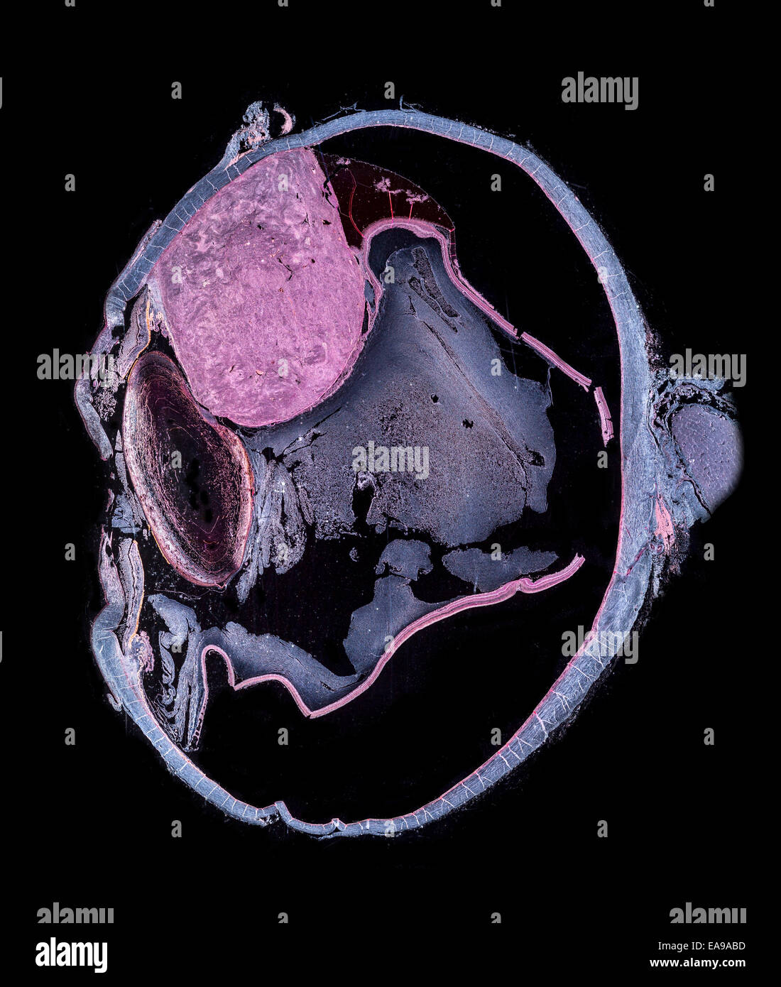 Human eye section showing structure with diseased melanotic tumor (large pink area) darkfield photomicrograph Stock Photo