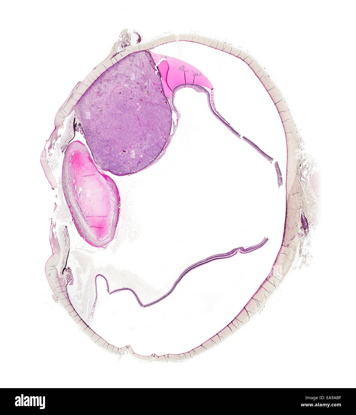 Human eye section showing structure with diseased melanotic tumor (large pink area) brightfield photomicrograph Stock Photo