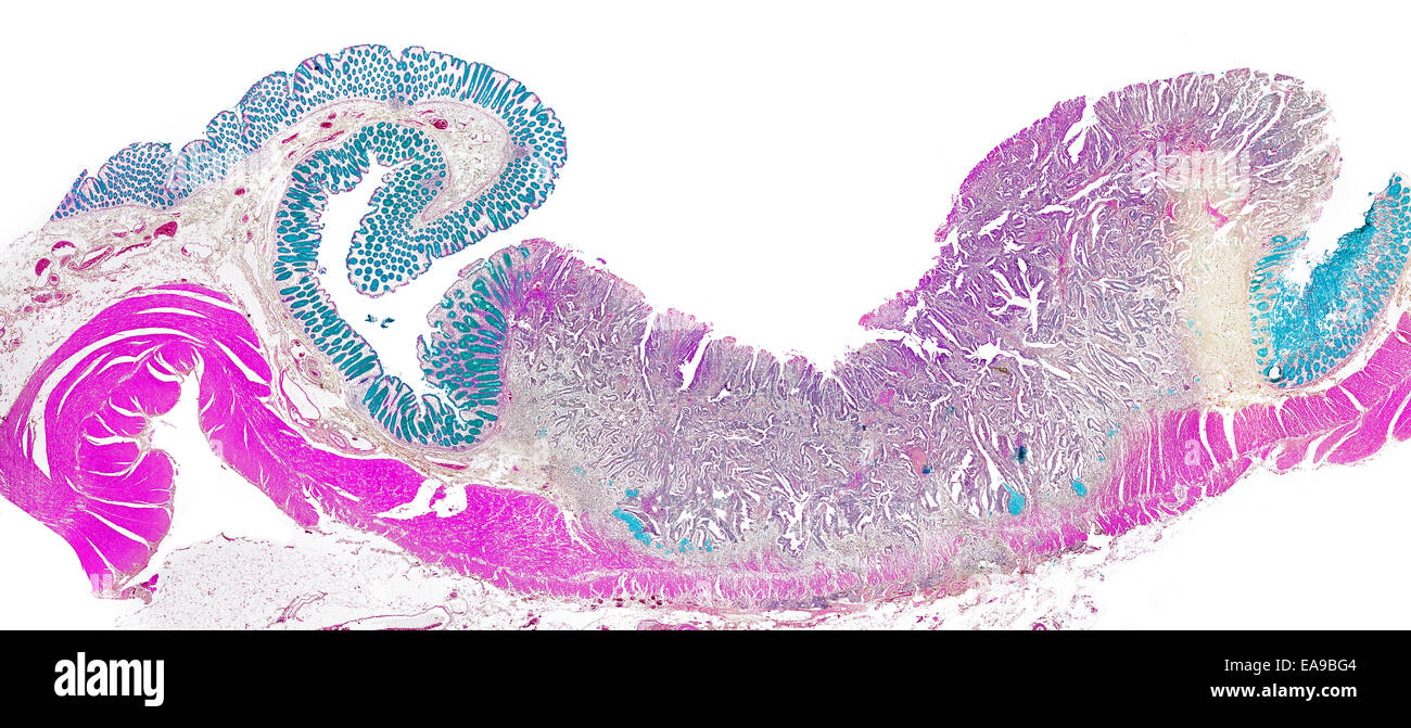 Homo sapiens, colon intestine cancer, carcinoma. stained section brightfield photomicrograph Stock Photo